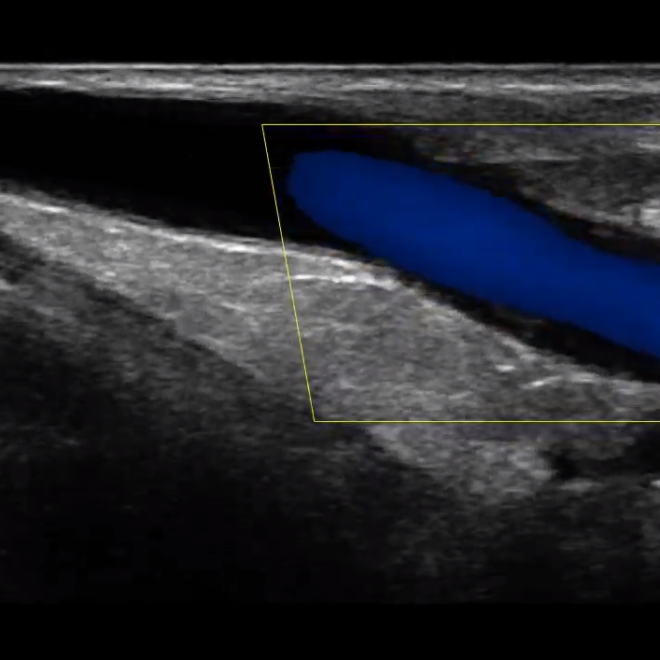 Basilic Vein EMED