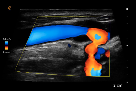 acesso vascular l7